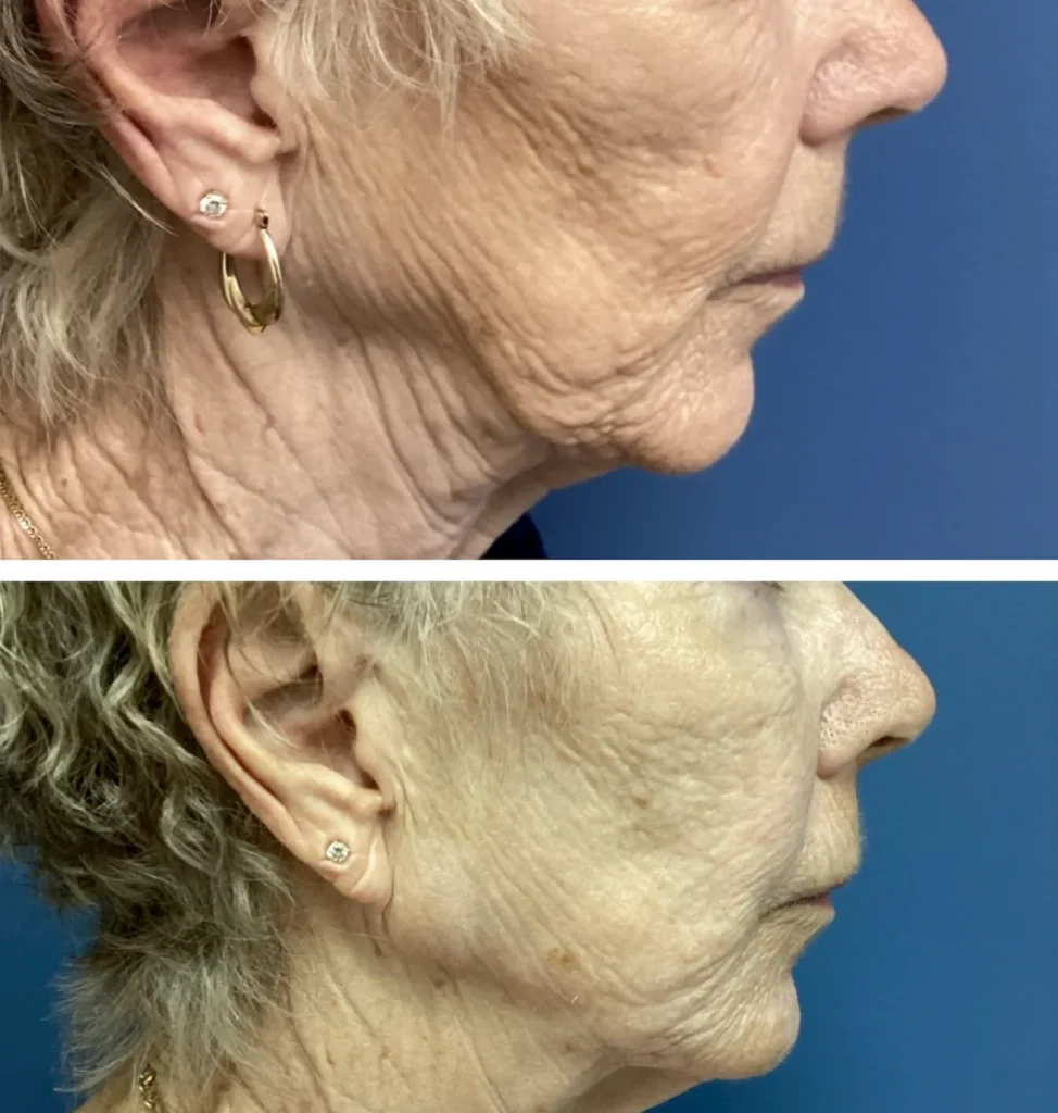 Jawline Filler Before and After