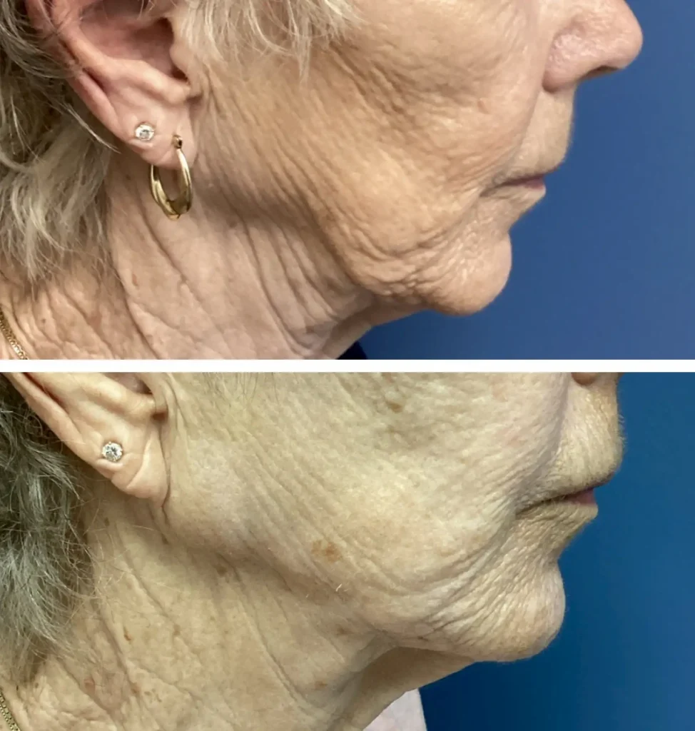 Jawline filler before and after 2