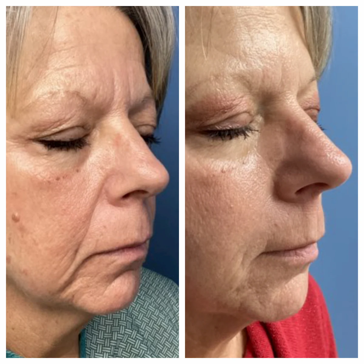 Nasolabial fold filler before and after, both oblique views — St. Louis Dermatology & Cosmetic Surgery