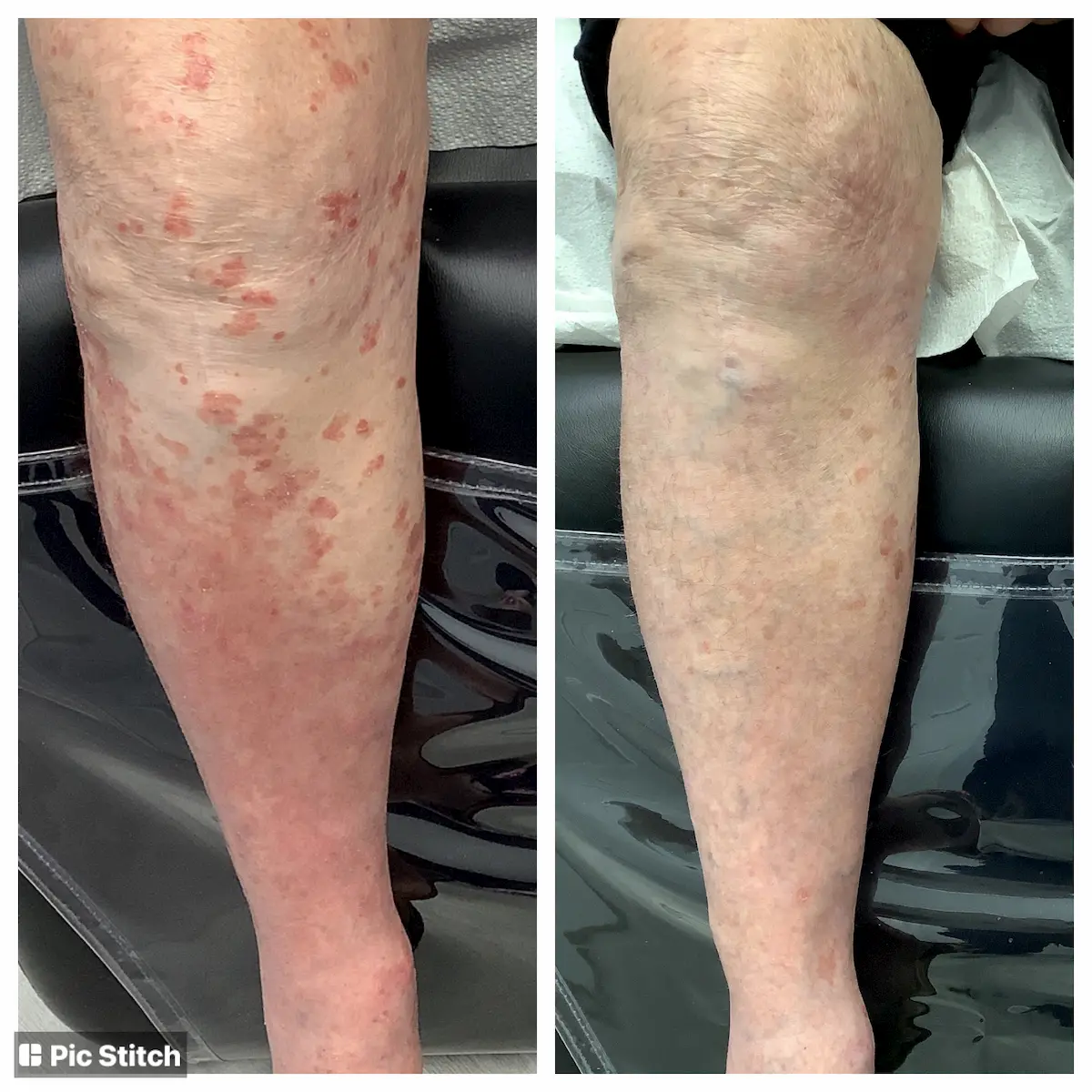 Eczema, psoriasis and rash treatment before and after — St. Louis Dermatology & Cosmetic Surgery