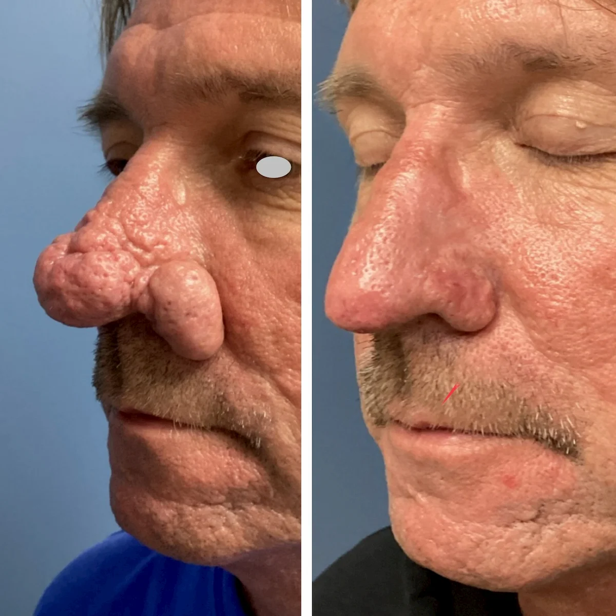Rhinophyma surgical recontouring of the nose, before and after, oblique view — St. Louis Dermatology & Cosmetic Surgery