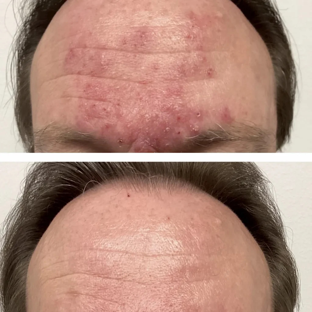 Rosacea 0