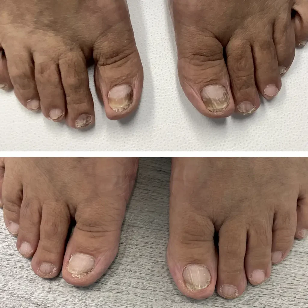 Toe Nail Fungus Before and After copy