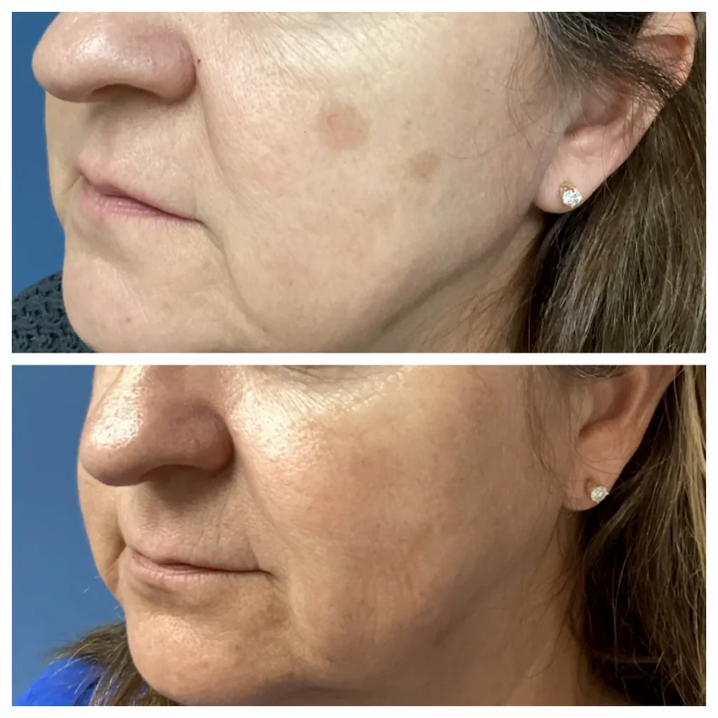 chemical peel before and after 1