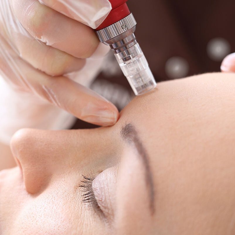 microneedling-jacksonville