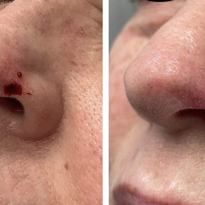 nose-surgery-before-and-after (3)