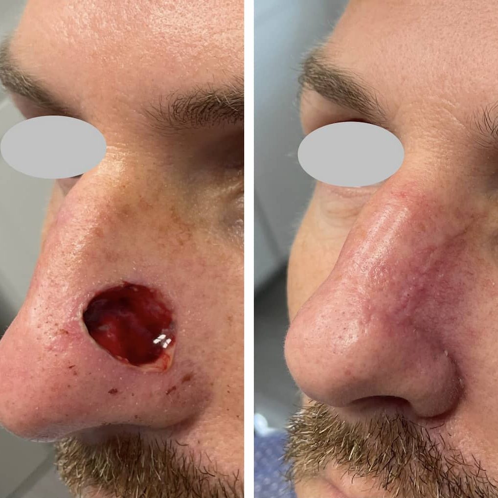 nose-surgery-before-and-after (4)