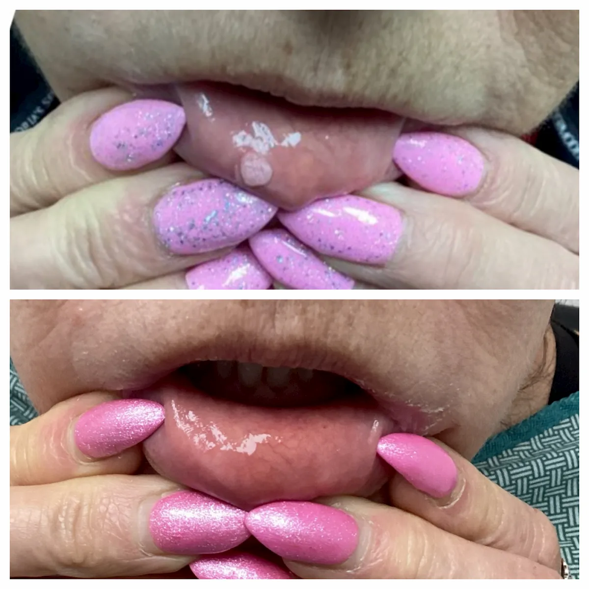 Wart on the lip before and after removal by excision — St. Louis Dermatology & Cosmetic Surgery