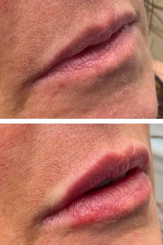 lip-filler