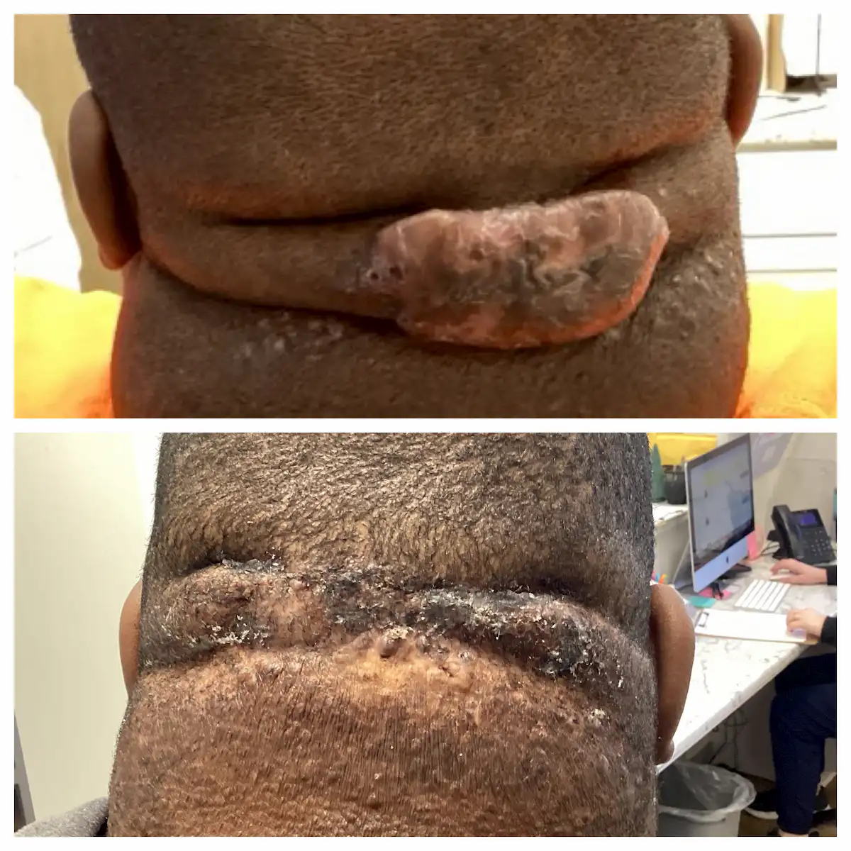 Posterior neck keloid treatment before and after — St. Louis Dermatology & Cosmetic Surgery