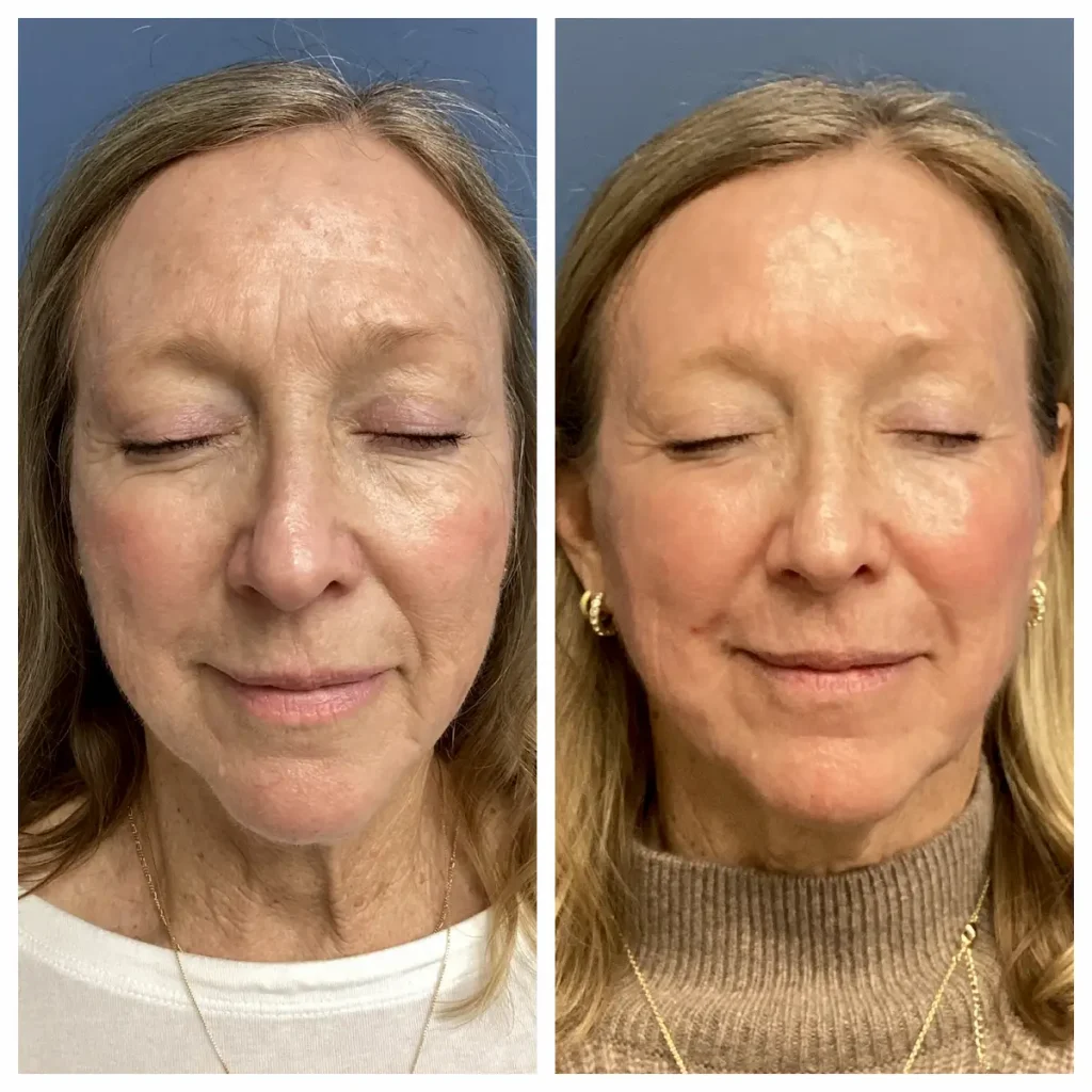 co2 laser treatment