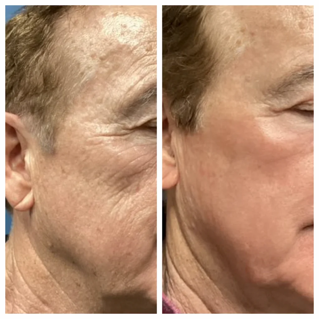 co2-laser-treatment-2