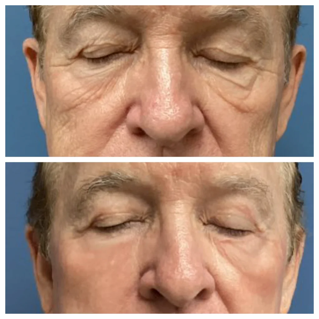 co2-laser-treatment-1