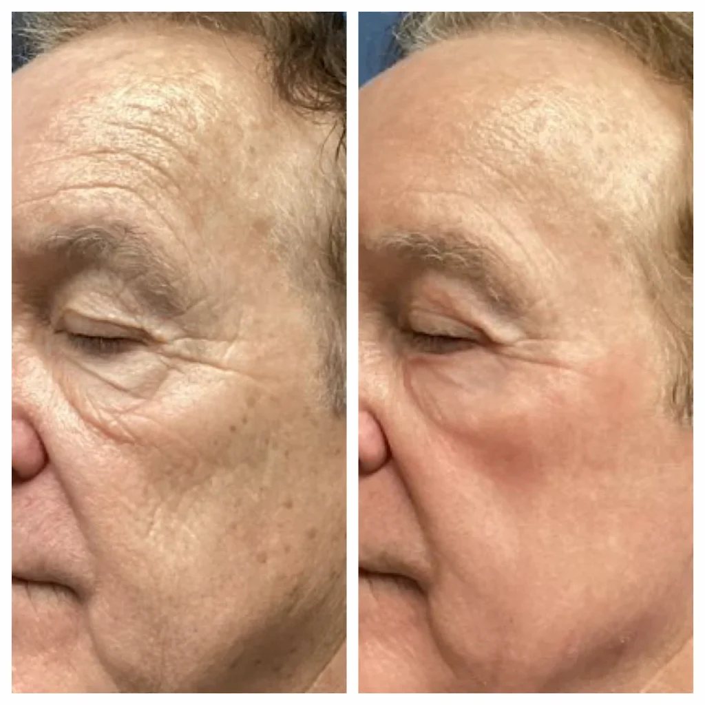 co2-laser-treatment