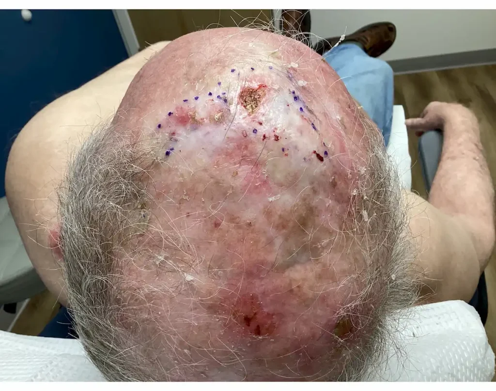 Actinic Keratosis Before and After