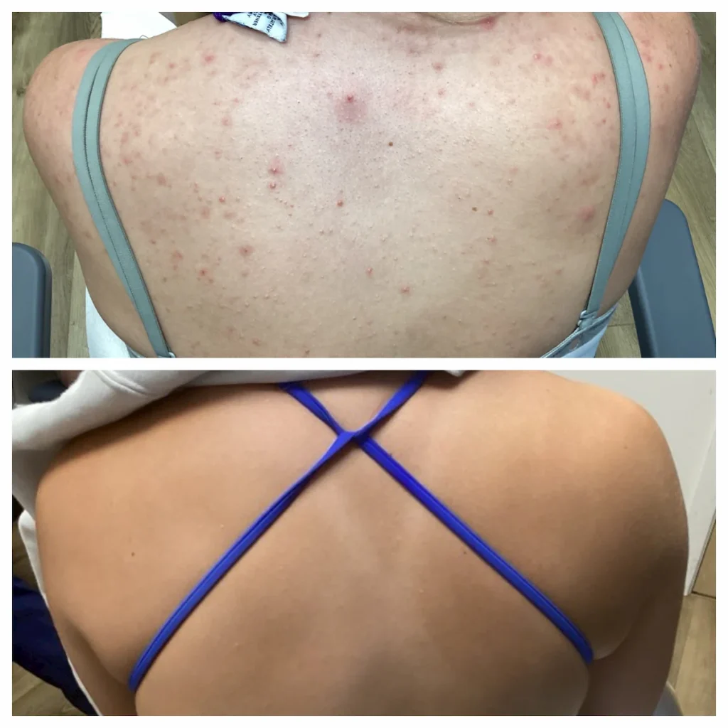before and after Accutane back