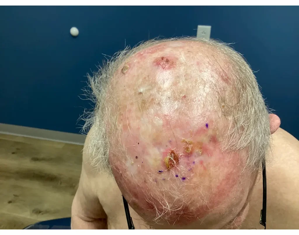 Actinic Keratosis Before and After