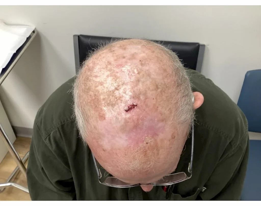 Actinic Keratosis Before and After