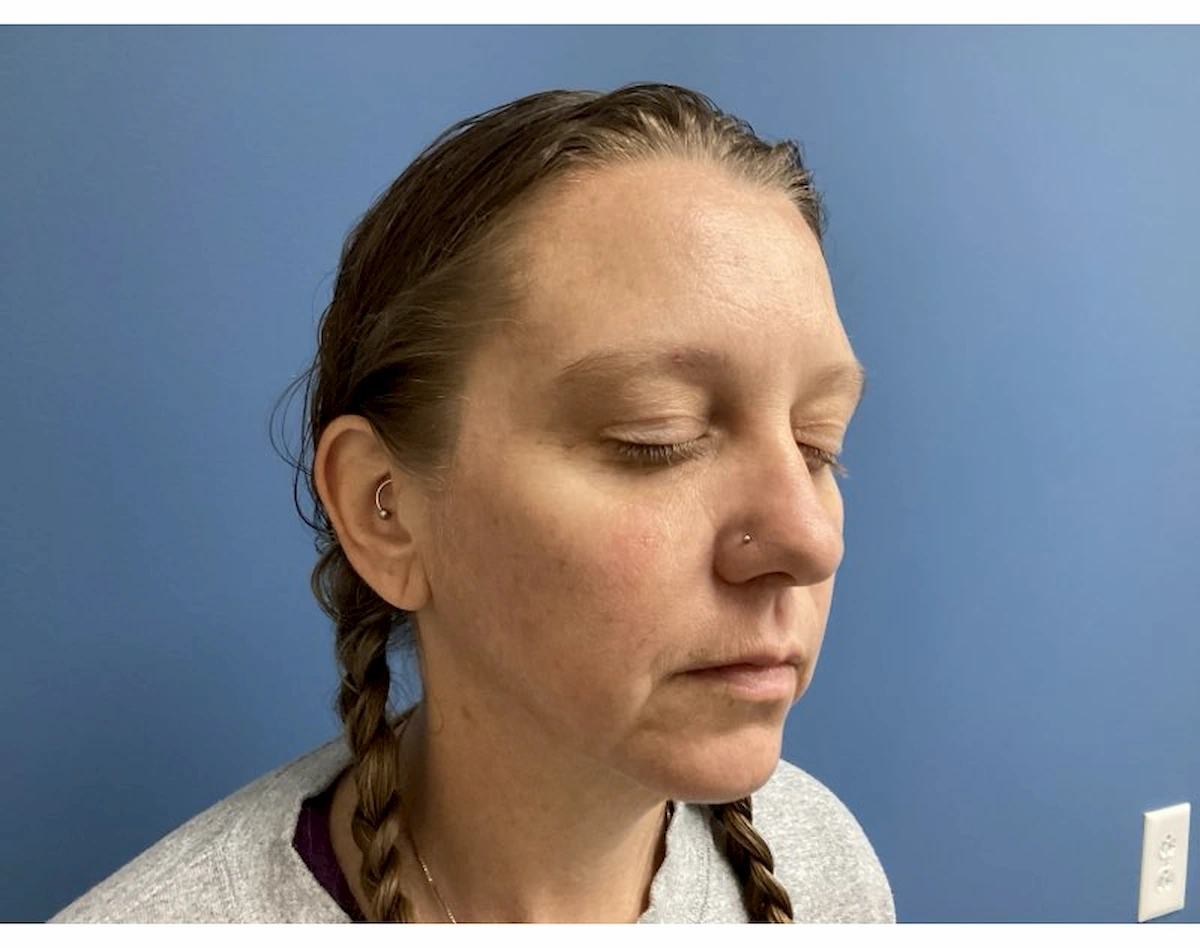 Xeomin for forehead and frown lines, after treatment — St. Louis Dermatology & Cosmetic Surgery