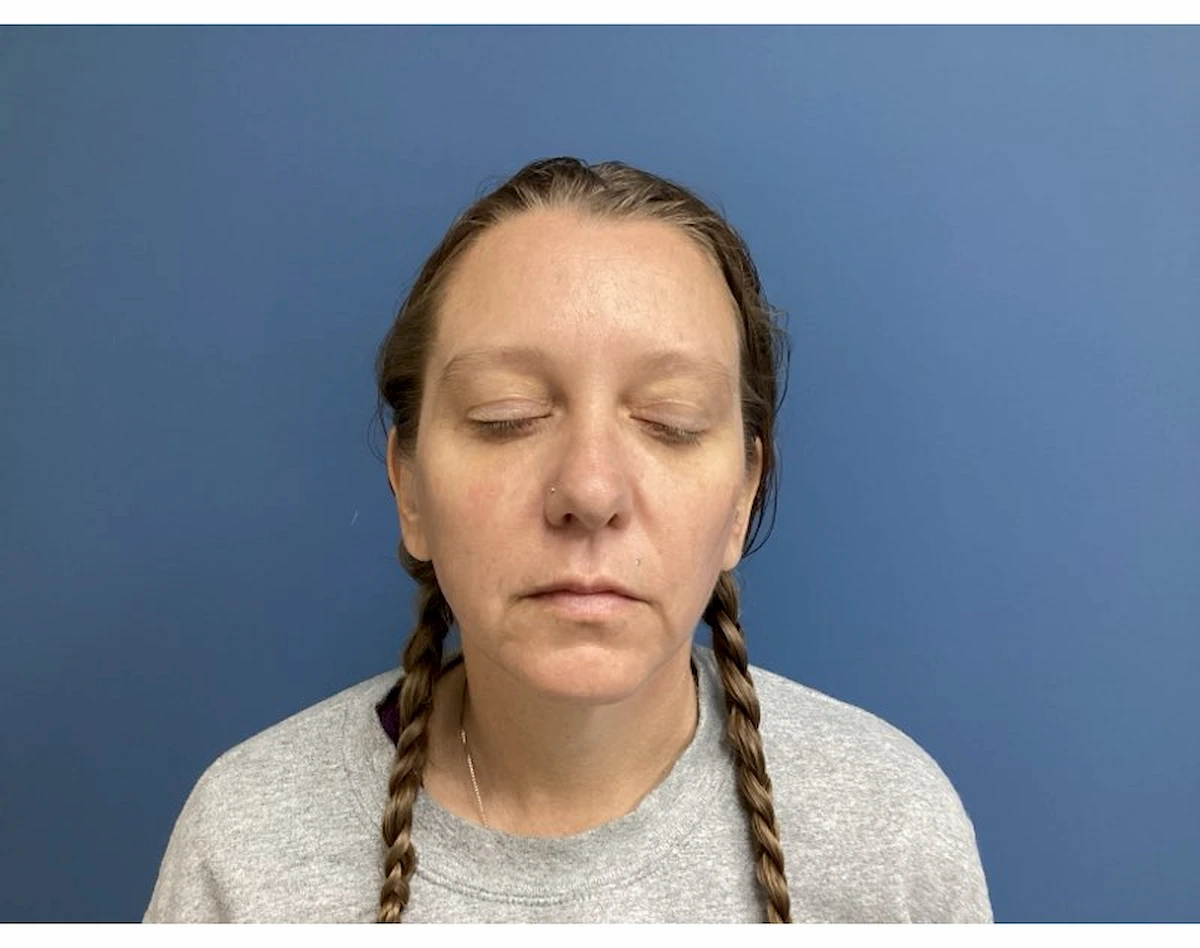 Xeomin for forehead and frown lines, second patient, after treatment — St. Louis Dermatology & Cosmetic Surgery