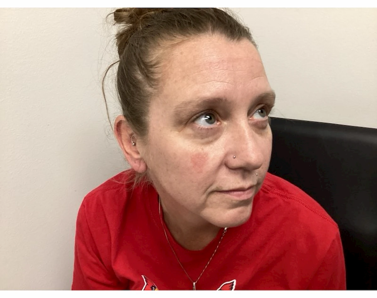 Xeomin for forehead and frown lines, before treatment — St. Louis Dermatology & Cosmetic Surgery