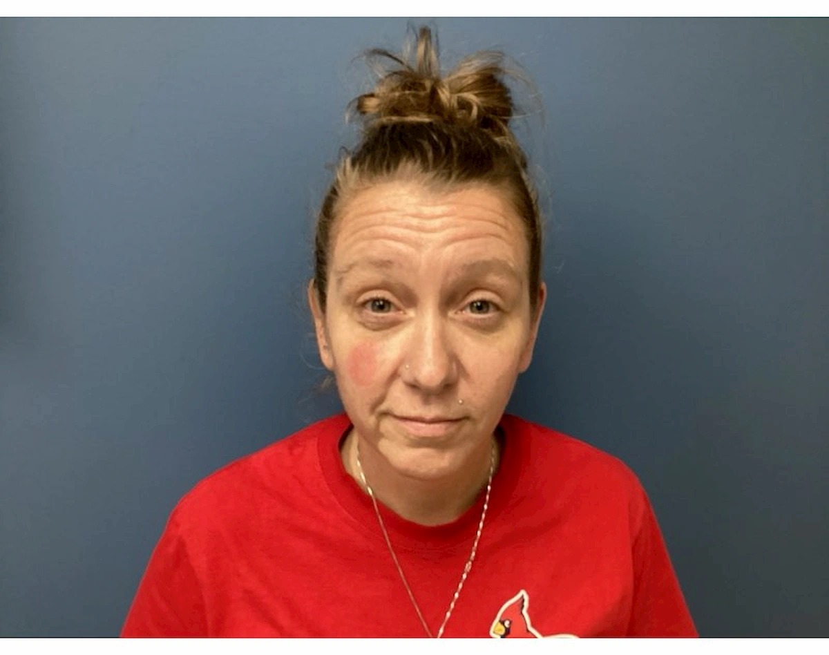 Xeomin for forehead and frown lines, second patient, before treatment — St. Louis Dermatology & Cosmetic Surgery