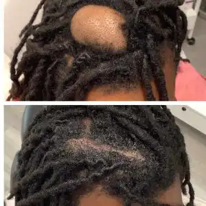 cyst-removal