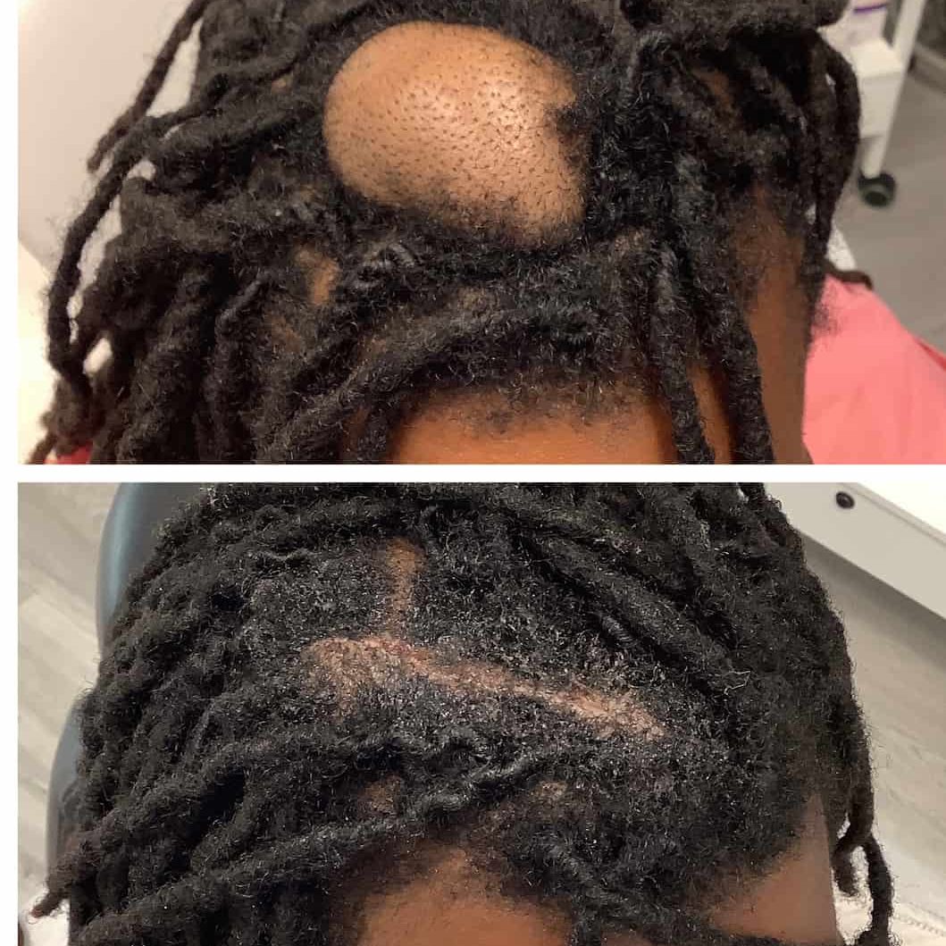 cyst-removal