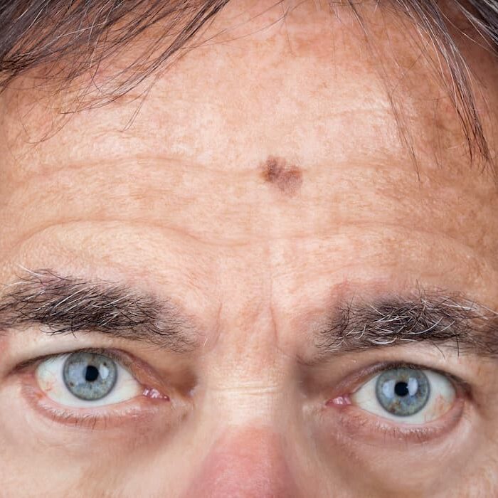 melanoma-man