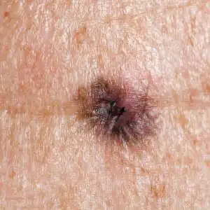 melanoma-st-louis-pic