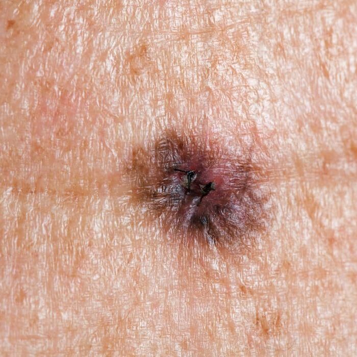 melanoma-st-louis-pic