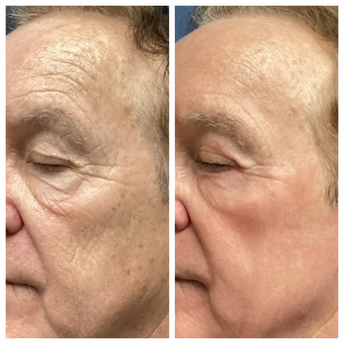 Male full-face CO2 laser resurfacing before and after, second view — St. Louis Dermatology & Cosmetic Surgery