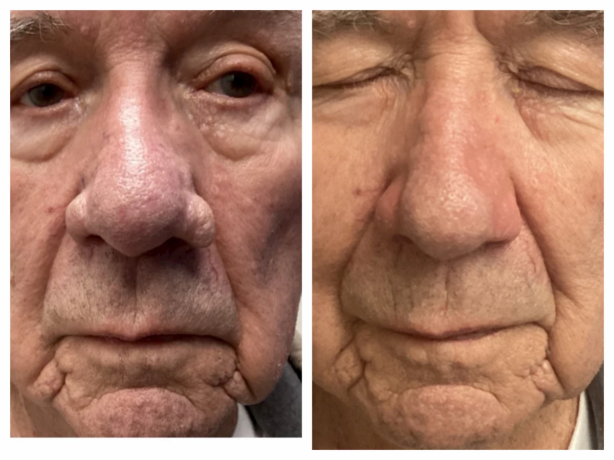 Rhinophyma surgical recontouring of the nose, before and after, front view — St. Louis Dermatology & Cosmetic Surgery