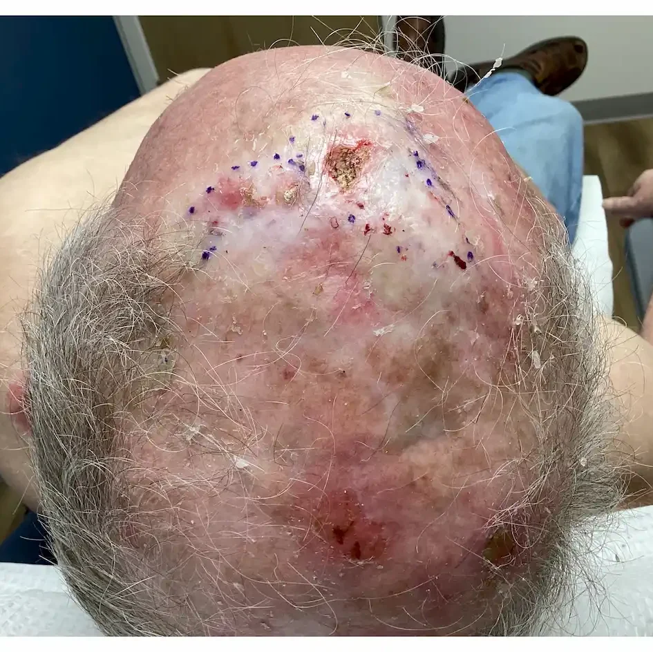 Actinic Keratosis Before and After