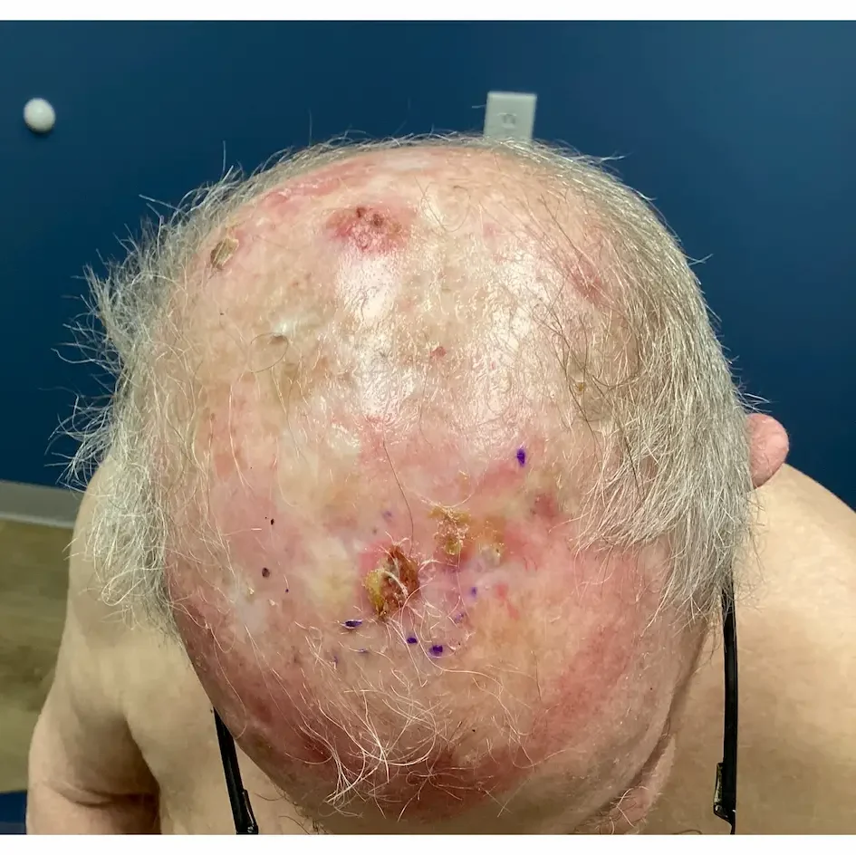 Actinic Keratosis Before and After