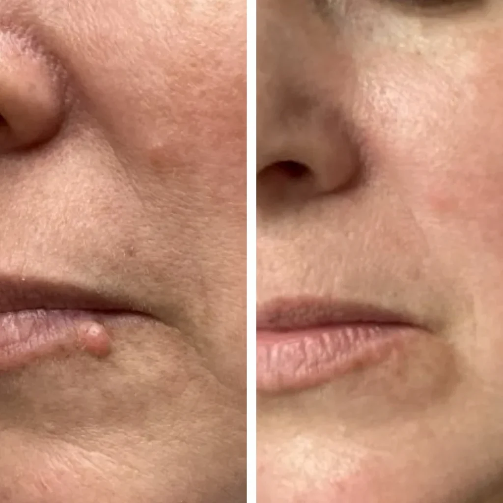 lip_mole_removal