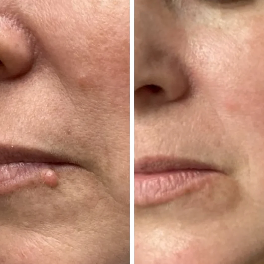lip_mole_removal