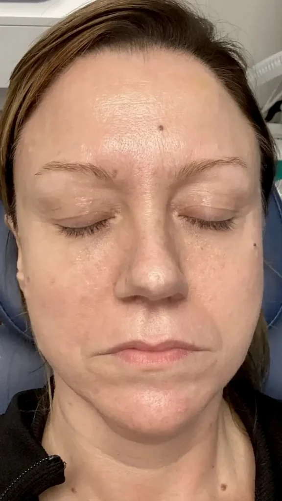 mole-melting-before-and-after