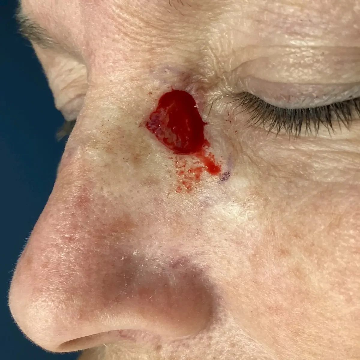 nasal sidewall before 1