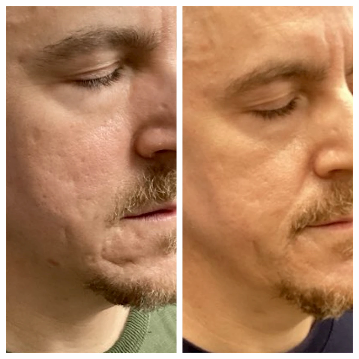 Acne scarring treated with CO2 laser and subcision before and after, second view — St. Louis Dermatology & Cosmetic Surgery