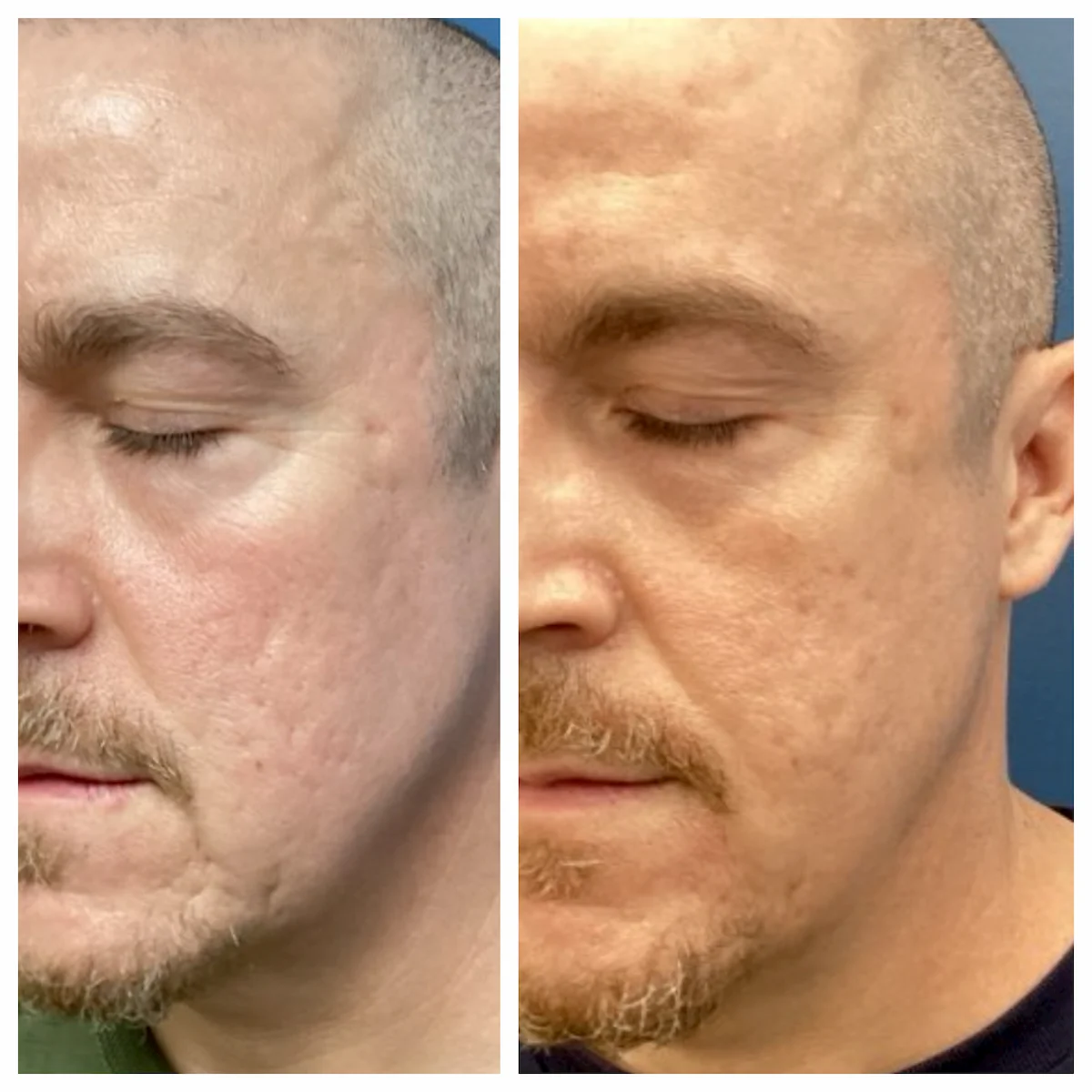 Acne scarring treated with CO2 laser and subcision before and after — St. Louis Dermatology & Cosmetic Surgery