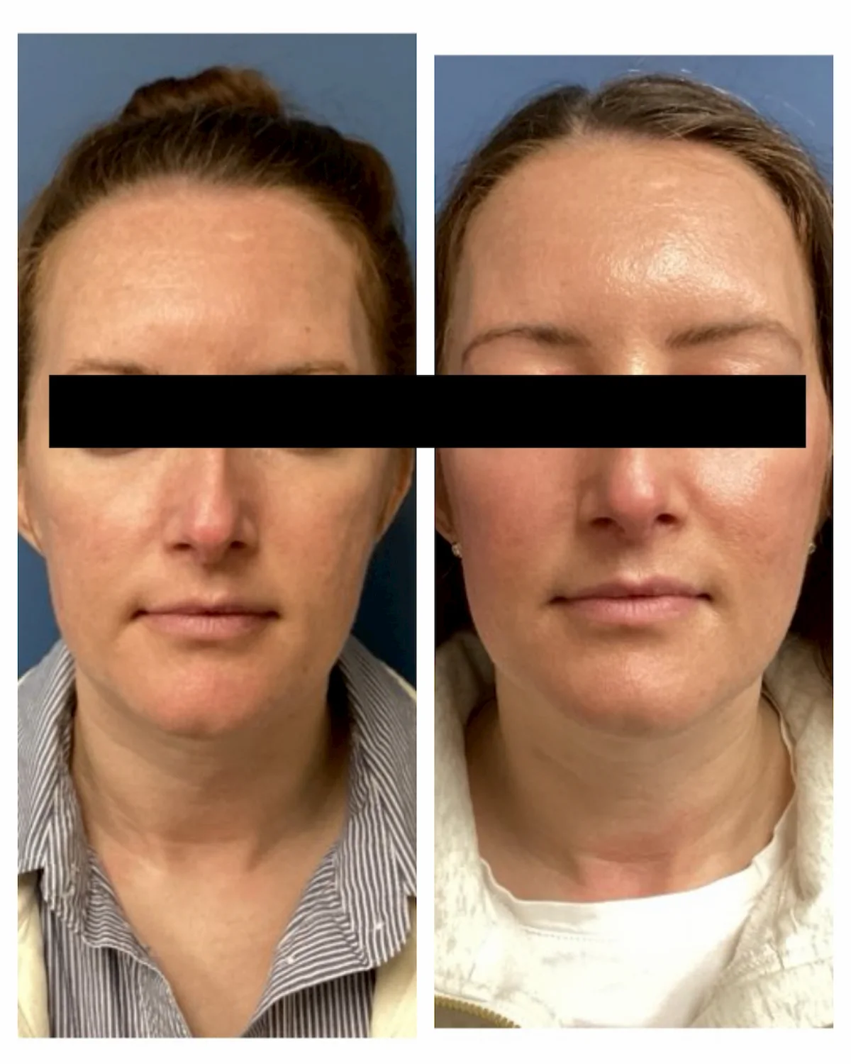 Acne scarring treated with subcision, TCA CROSS, and CO2 before and after, front view — St. Louis Dermatology & Cosmetic Surgery