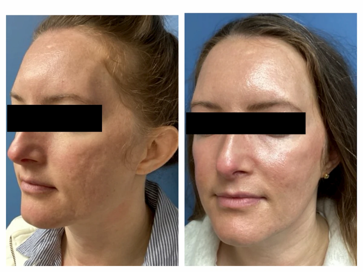 Acne scarring treated with subcision, TCA CROSS, and CO2 before and after, left view — St. Louis Dermatology & Cosmetic Surgery
