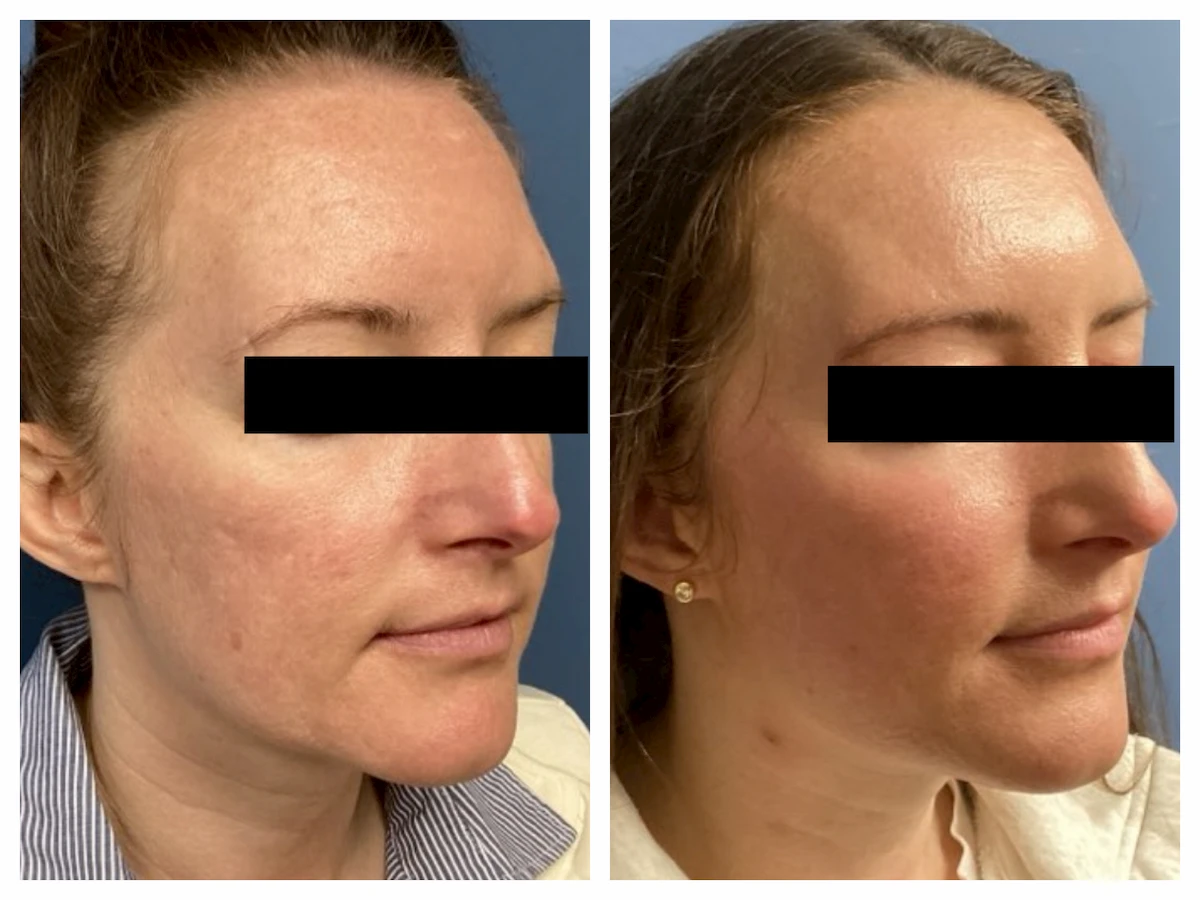 Acne scarring treated with subcision, TCA CROSS, and CO2 before and after, right view — St. Louis Dermatology & Cosmetic Surgery