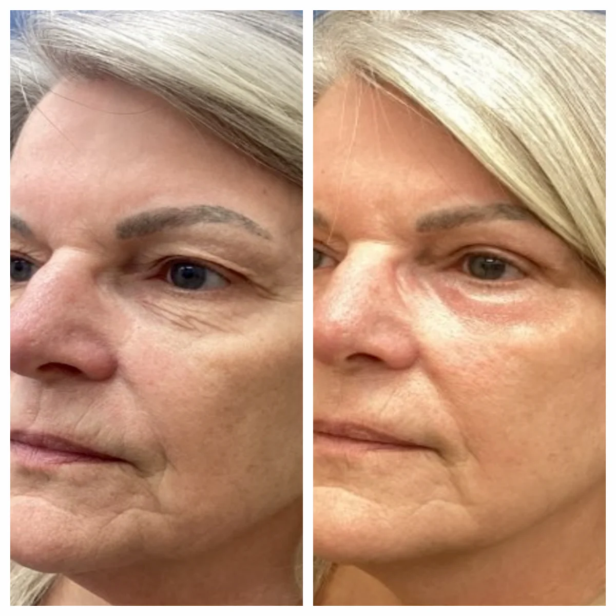 Eyelid surgery with CO2 laser resurfacing before and after, 45-degree view — St. Louis Dermatology & Cosmetic Surgery