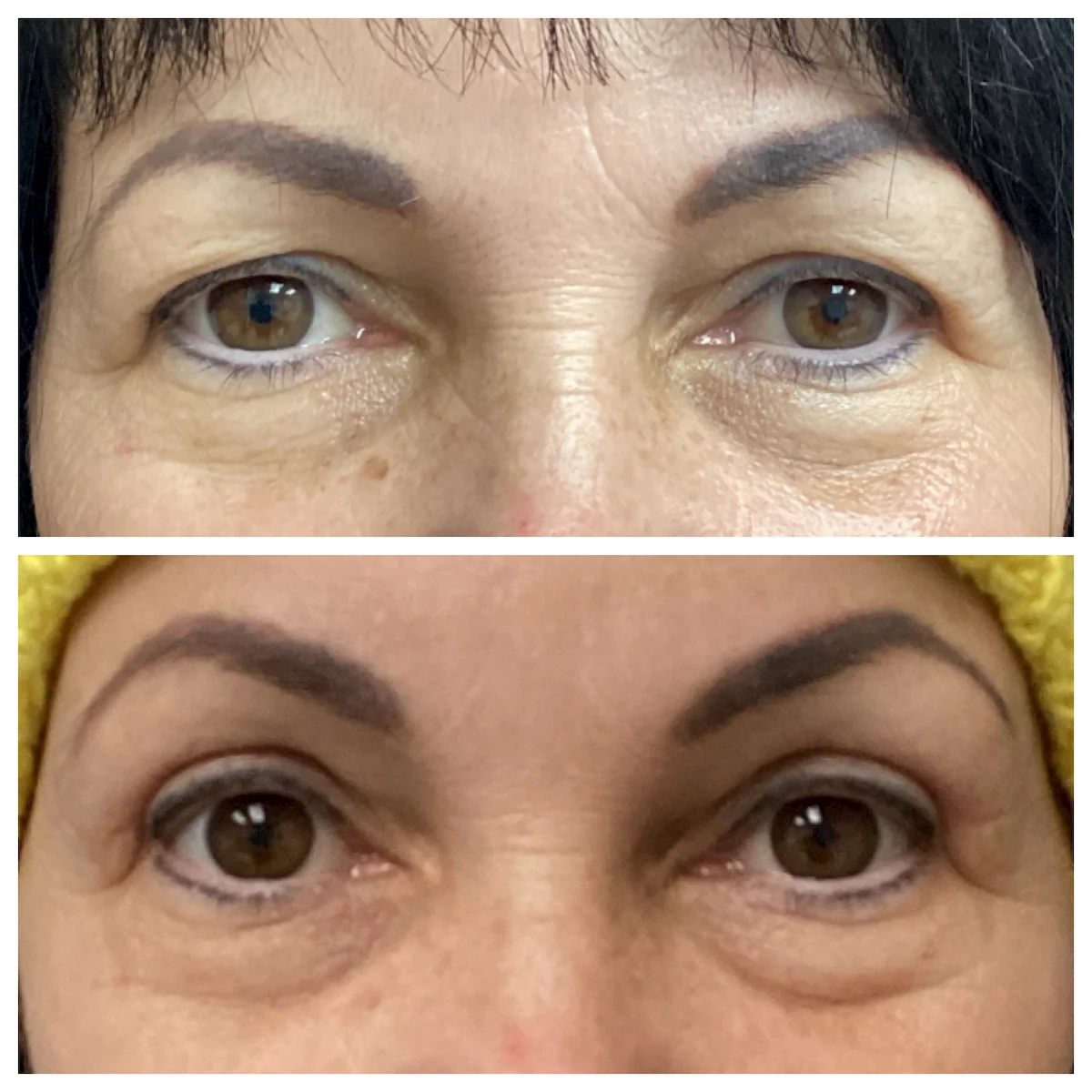 Upper eyelid blepharoplasty before and after, front view — St. Louis Dermatology & Cosmetic Surgery