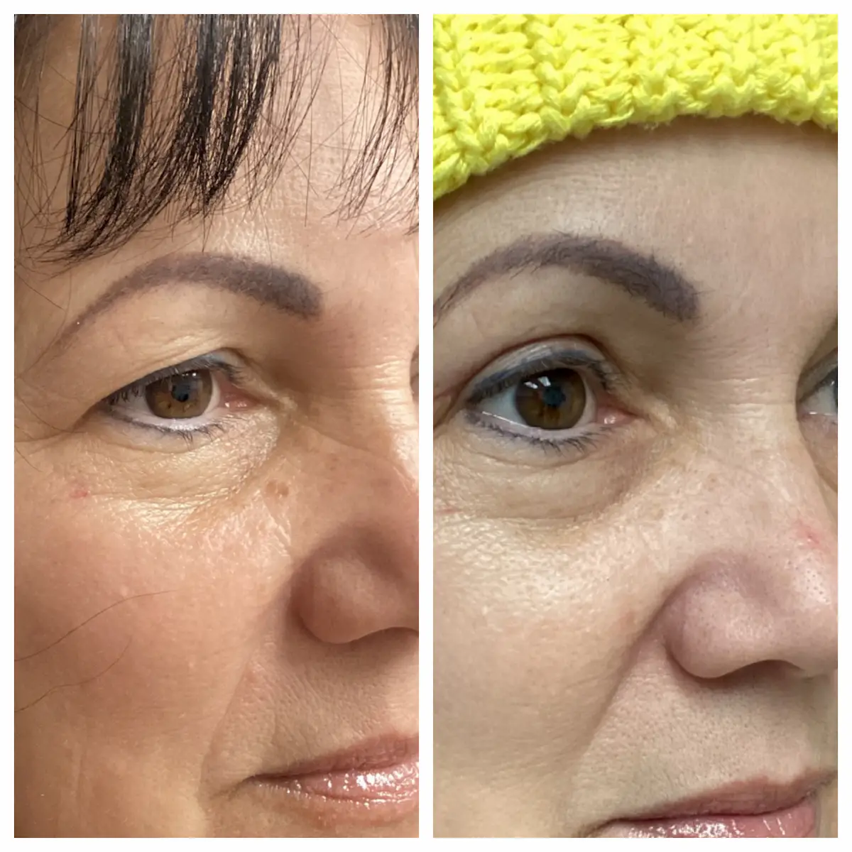 Upper eyelid blepharoplasty before and after, side view — St. Louis Dermatology & Cosmetic Surgery