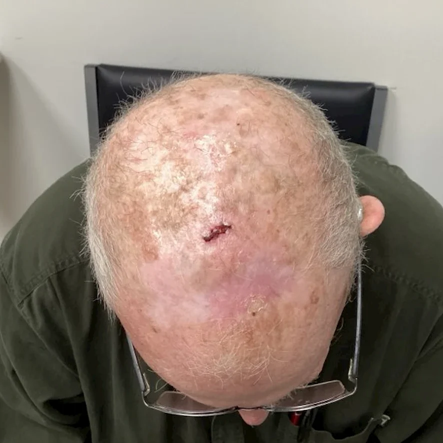 Actinic Keratosis Before and After