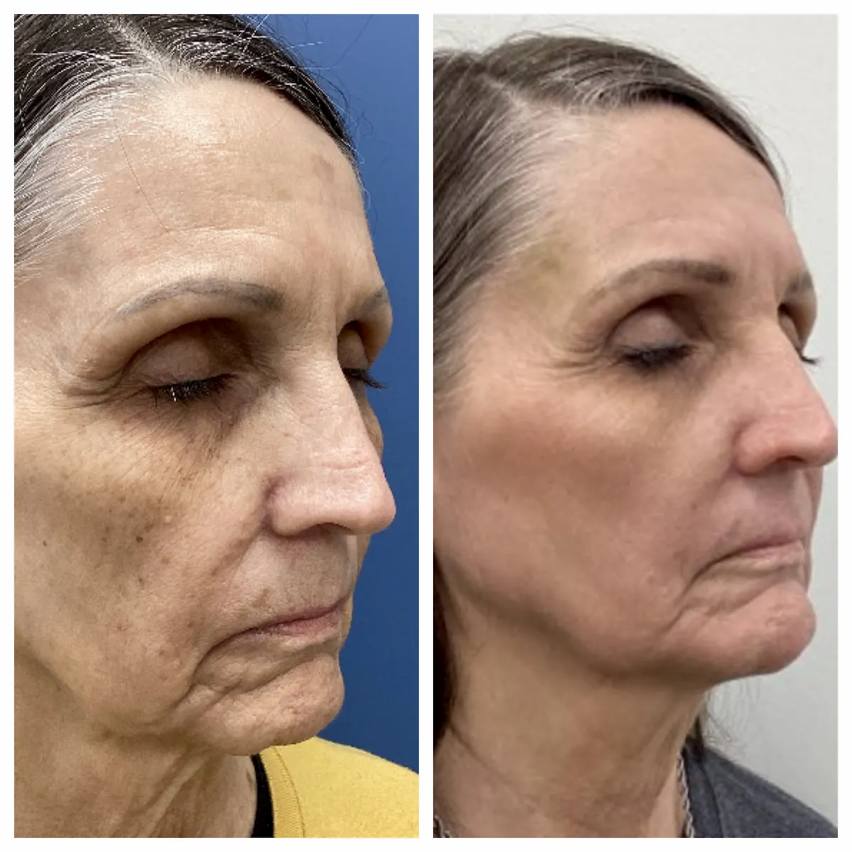 IPL for facial brown spots before and after, profile view — St. Louis Dermatology & Cosmetic Surgery