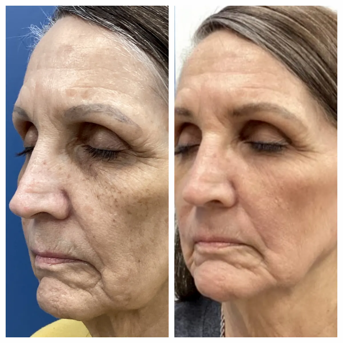 IPL for facial brown spots and freckling before and after — St. Louis Dermatology & Cosmetic Surgery
